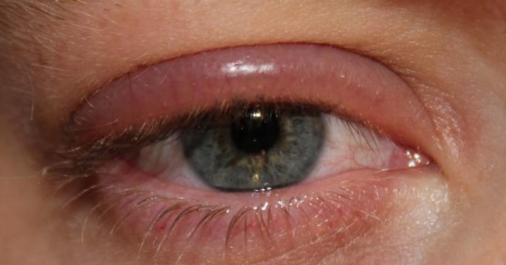 Блефарит глаз (век) — симптомы, причины и лечение в домашних условиях